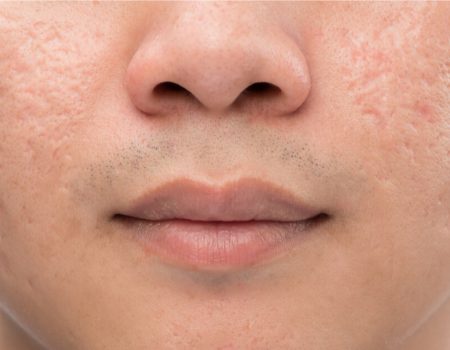 Acne And Acne Scars