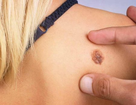 Precancerous Lesions
