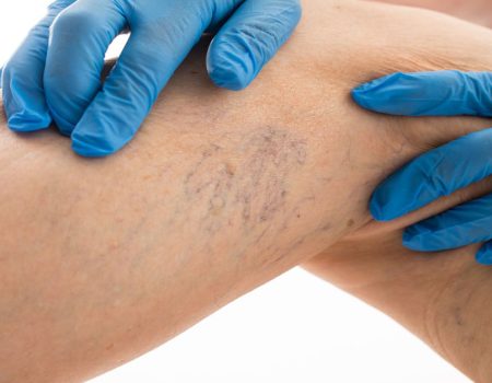 Vascular Lesions